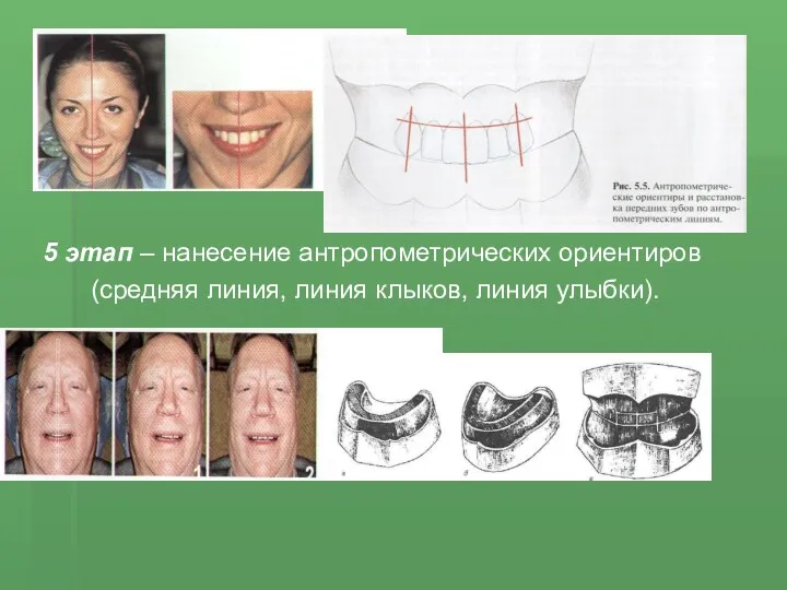 5 этап – нанесение антропометрических ориентиров (средняя линия, линия клыков, линия улыбки).