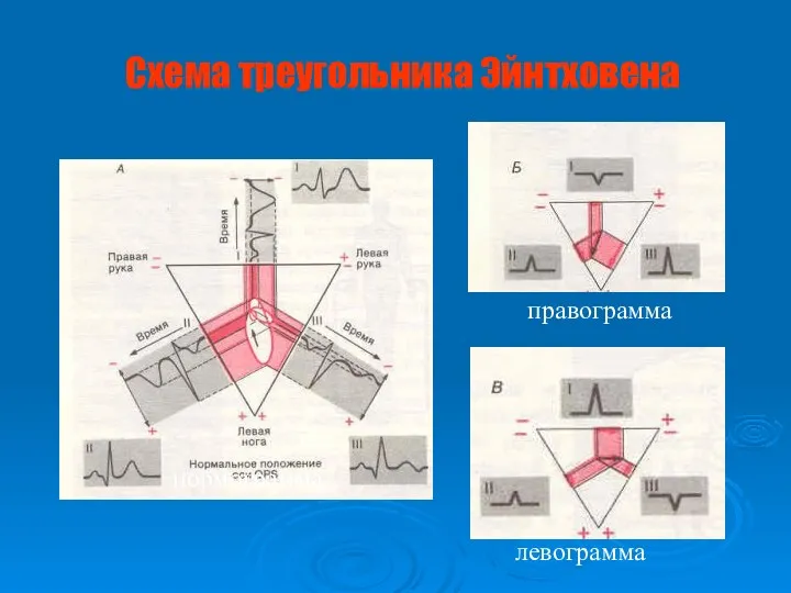 Схема треугольника Эйнтховена правограмма левограмма нормограмма