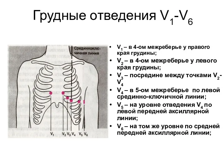 Грудные отведения V1-V6 V1 – в 4-ом межреберье у правого