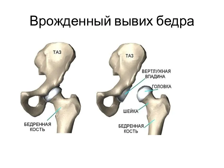 Врожденный вывих бедра