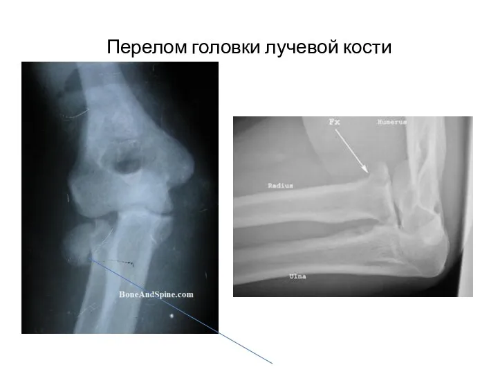 Перелом головки лучевой кости