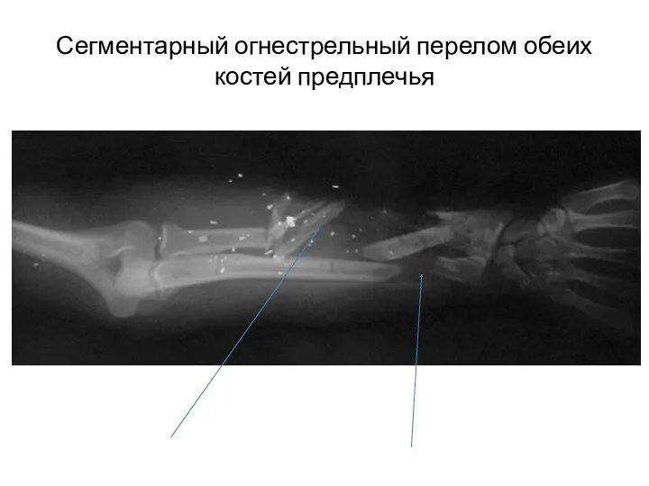 Сегментарный огнестрельный перелом обеих костей предплечья