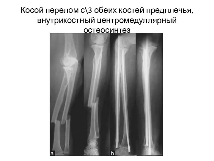 Косой перелом с\3 обеих костей предплечья, внутрикостный центромедуллярный остеосинтез
