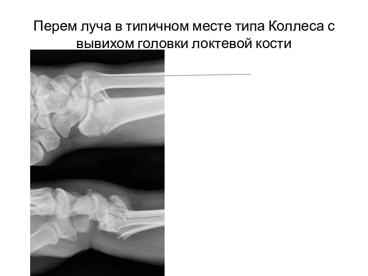 Перем луча в типичном месте типа Коллеса с вывихом головки локтевой кости