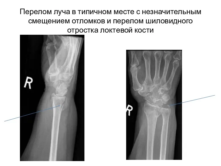 Перелом луча в типичном месте с незначительным смещением отломков и перелом шиловидного отростка локтевой кости