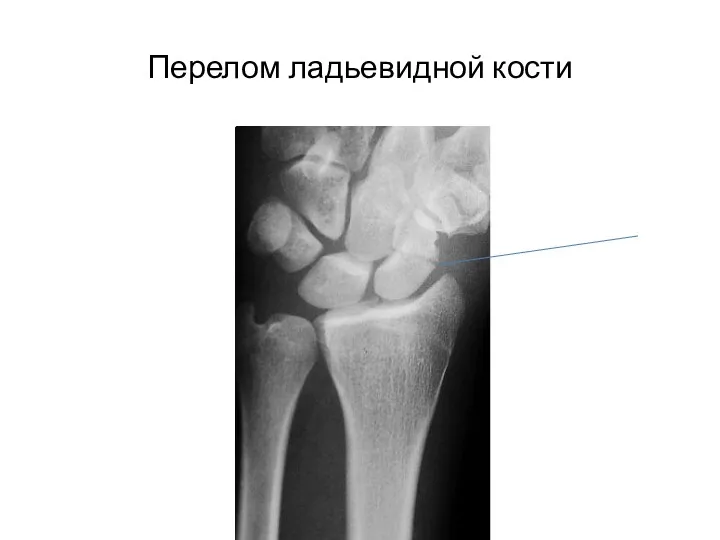 Перелом ладьевидной кости