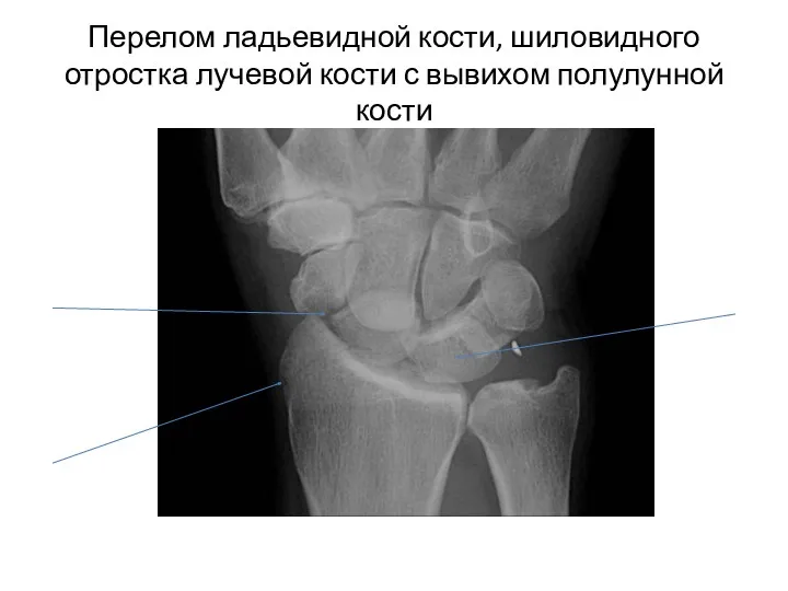 Перелом ладьевидной кости, шиловидного отростка лучевой кости с вывихом полулунной кости