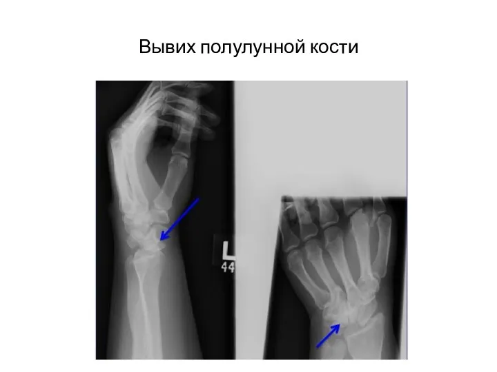 Вывих полулунной кости