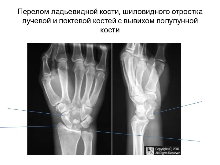 Перелом ладьевидной кости, шиловидного отростка лучевой и локтевой костей с вывихом полулунной кости