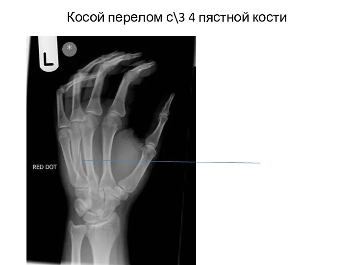 Косой перелом с\3 4 пястной кости