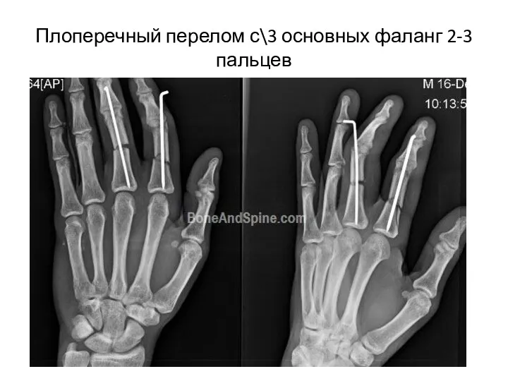 Плоперечный перелом с\3 основных фаланг 2-3 пальцев