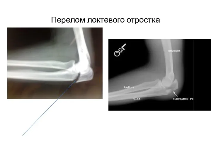 Перелом локтевого отростка