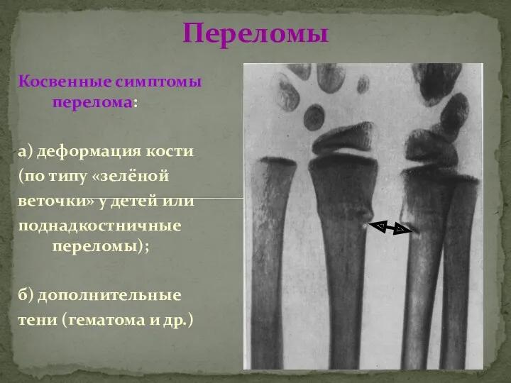 Косвенные симптомы перелома: а) деформация кости (по типу «зелёной веточки»