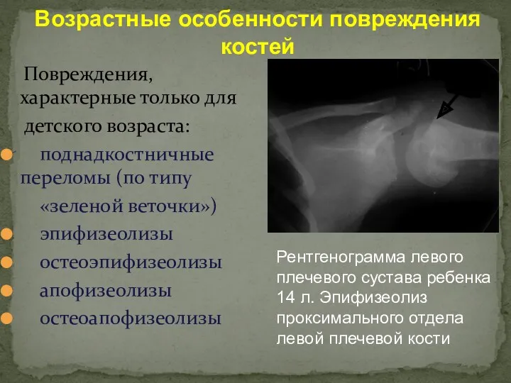 Повреждения, характерные только для детского возраста: поднадкостничные переломы (по типу