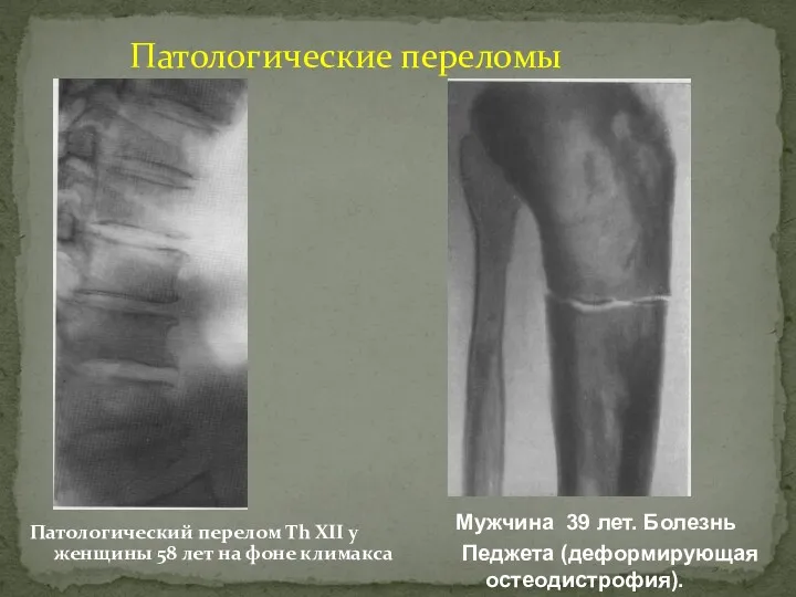 Патологический перелом Th XII у женщины 58 лет на фоне