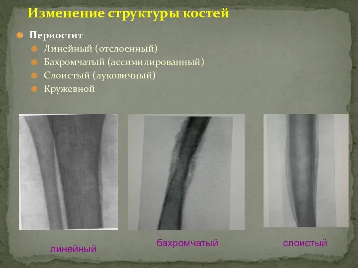 Периостит Линейный (отслоенный) Бахромчатый (ассимилированный) Слоистый (луковичный) Кружевной Изменение структуры костей линейный слоистый бахромчатый