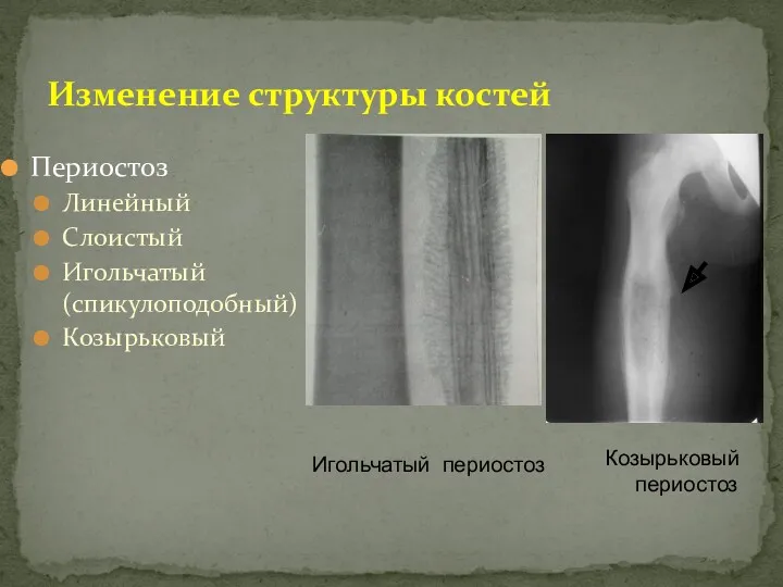 Периостоз Линейный Слоистый Игольчатый (спикулоподобный) Козырьковый Изменение структуры костей Игольчатый периостоз Козырьковый периостоз