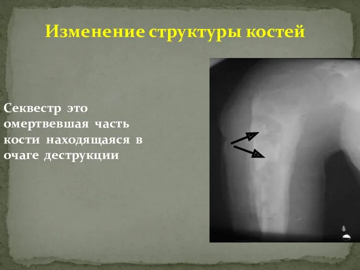 Изменение структуры костей Секвестр это омертвевшая часть кости находящаяся в очаге деструкции