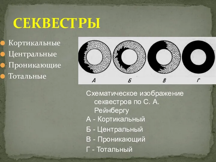 Кортикальные Центральные Проникающие Тотальные СЕКВЕСТРЫ Схематическое изображение секвестров по С.