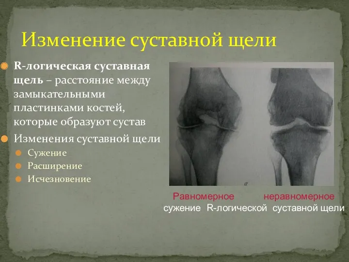 R-логическая суставная щель – расстояние между замыкательными пластинками костей, которые