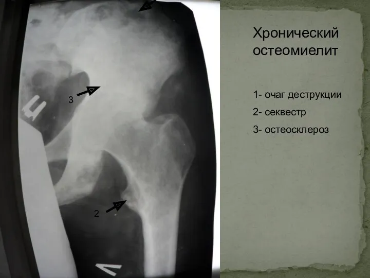 1 2 3 Хронический остеомиелит 1- очаг деструкции 2- секвестр 3- остеосклероз