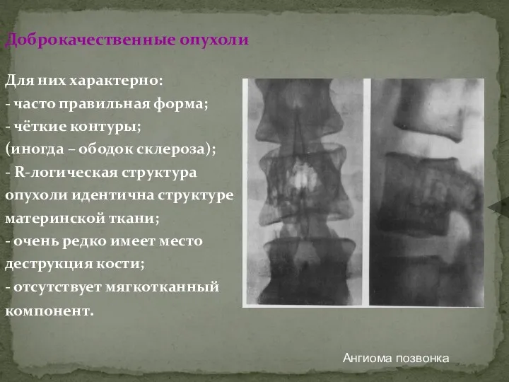 Доброкачественные опухоли Для них характерно: - часто правильная форма; -