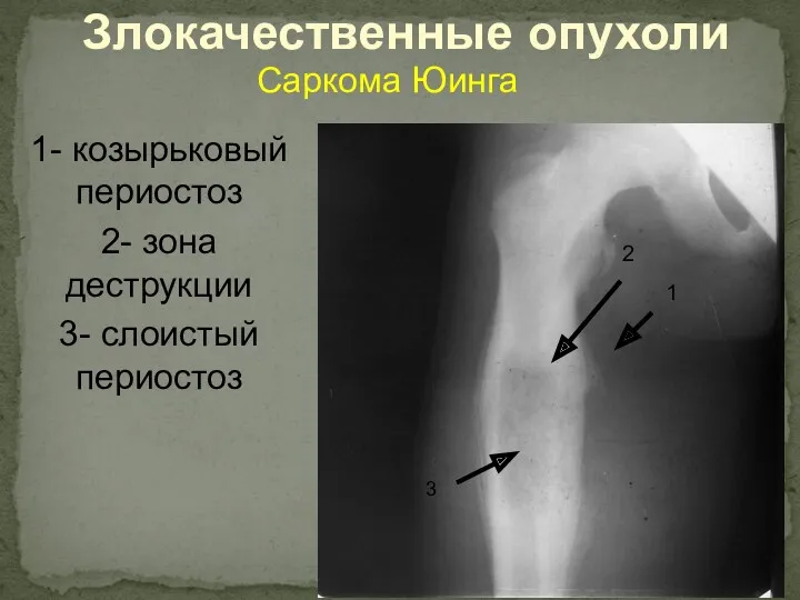 Злокачественные опухоли 1- козырьковый периостоз 2- зона деструкции 3- слоистый периостоз Саркома Юинга 1 2 3