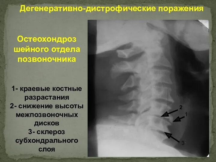 Дегенеративно-дистрофические поражения Остеохондроз шейного отдела позвоночника 1- краевые костные разрастания