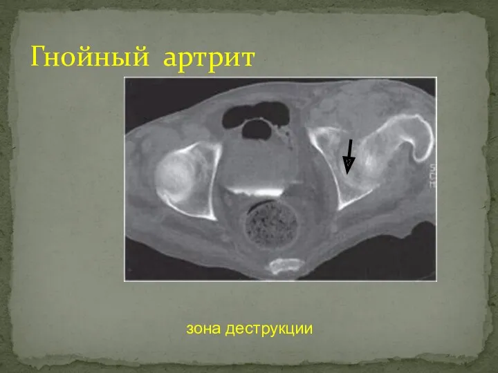 Гнойный артрит зона деструкции