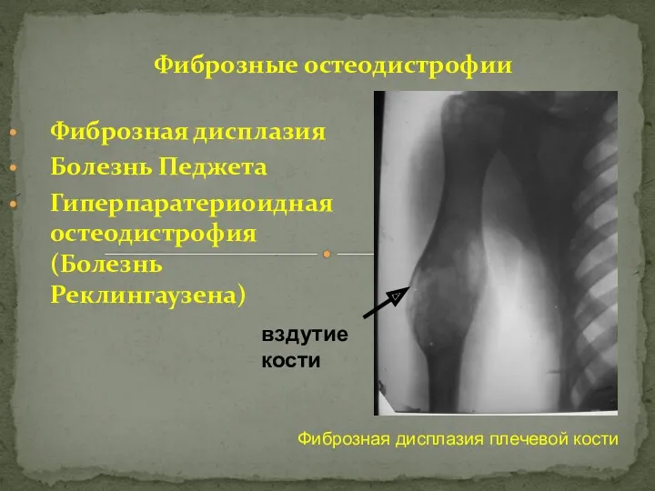 Фиброзная дисплазия Болезнь Педжета Гиперпаратериоидная остеодистрофия (Болезнь Реклингаузена) Фиброзные остеодистрофии Фиброзная дисплазия плечевой кости вздутие кости