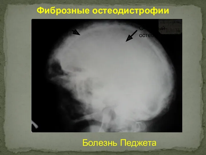 Фиброзные остеодистрофии Болезнь Педжета Утолщение кости Очаговый остеосклероз