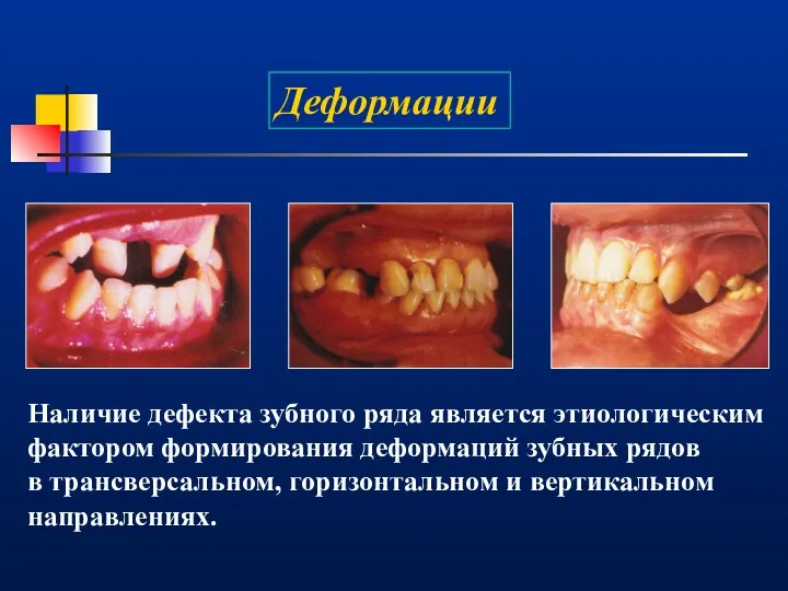 Деформации Наличие дефекта зубного ряда является этиологическим фактором формирования деформаций