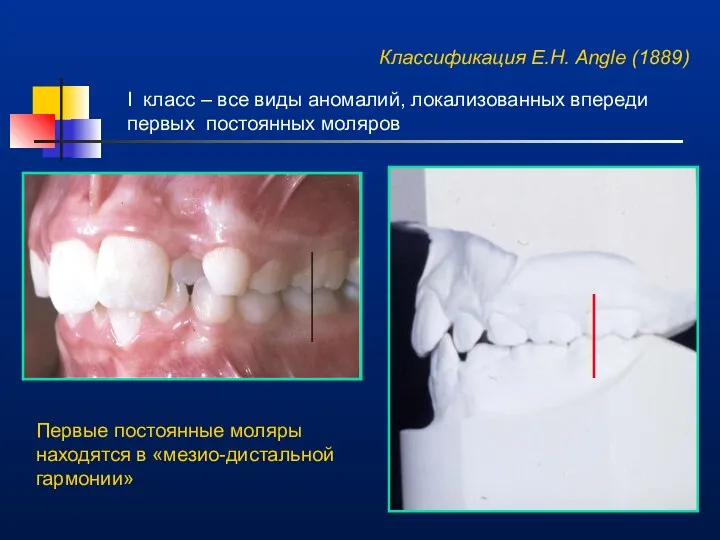 Классификация E.H. Angle (1889) I класс – все виды аномалий,