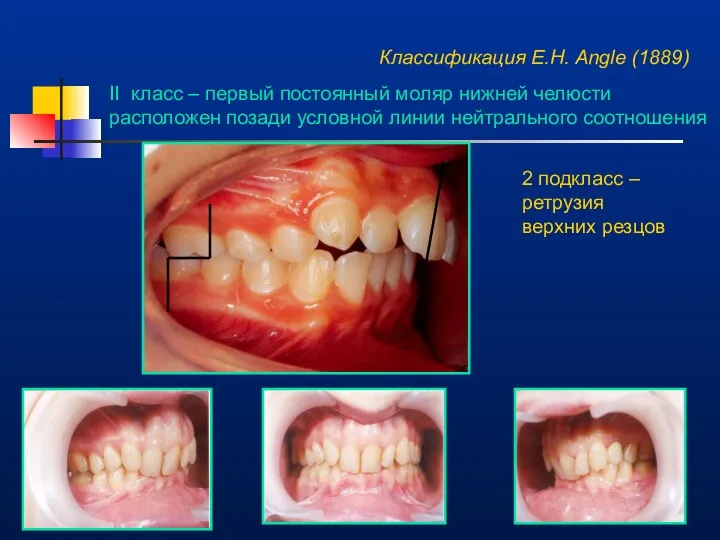 Классификация E.H. Angle (1889) II класс – первый постоянный моляр