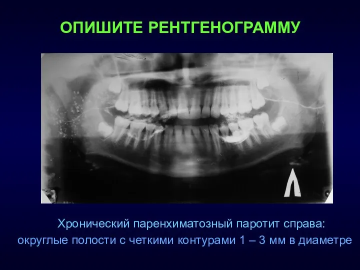 Хронический паренхиматозный паротит справа: округлые полости с четкими контурами 1 – 3 мм