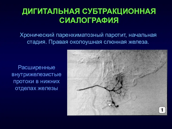 ДИГИТАЛЬНАЯ СУБТРАКЦИОННАЯ СИАЛОГРАФИЯ Хронический паренхиматозный паротит, начальная стадия. Правая околоушная слюнная железа. Расширенные