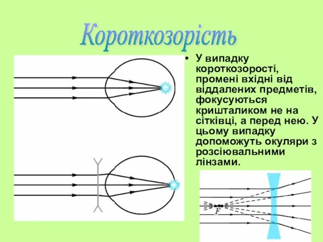 У випадку короткозорості, промені вхідні від віддалених предметів, фокусуються кришталиком