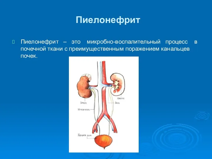Пиелонефрит Пиелонефрит – это микробно-воспалительный процесс в почечной ткани с преимущественным поражением канальцев почек.