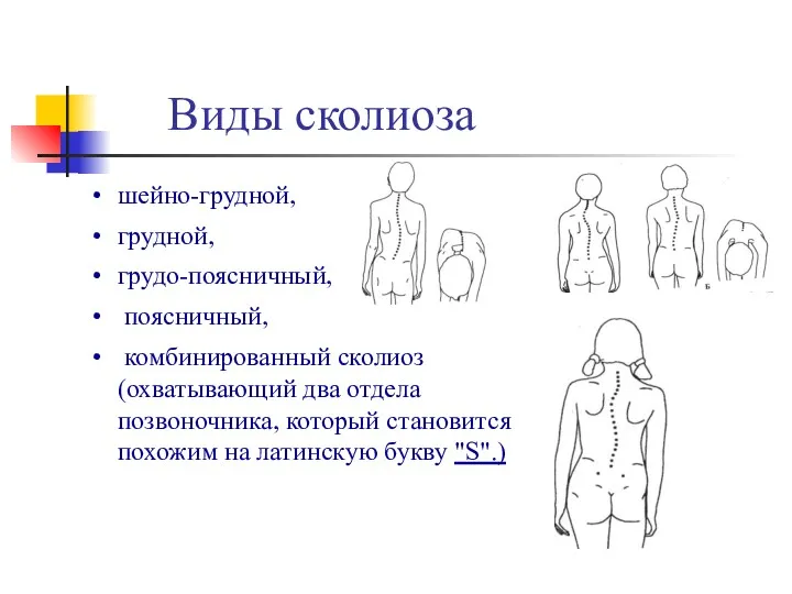 Виды сколиоза шейно-грудной, грудной, грудо-поясничный, поясничный, комбинированный сколиоз (охватывающий два отдела позвоночника, который