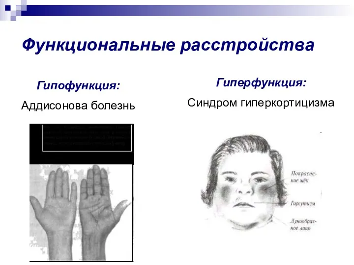 Функциональные расстройства Гипофункция: Аддисонова болезнь Гиперфункция: Синдром гиперкортицизма