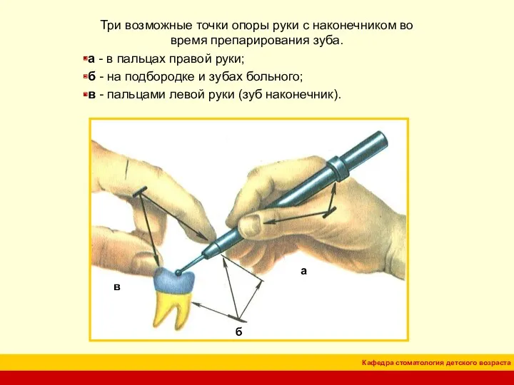 Три возможные точки опоры руки с наконечником во время препарирования зуба. а -