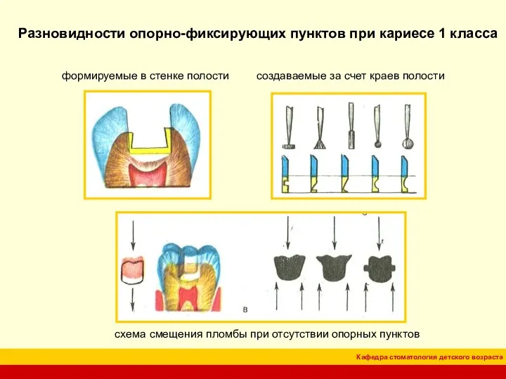 формируемые в стенке полости Разновидности опорно-фиксирующих пунктов при кариесе 1