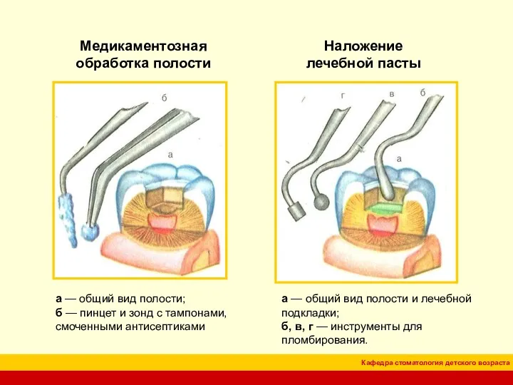 Медикаментозная обработка полости Наложение лечебной пасты а — общий вид