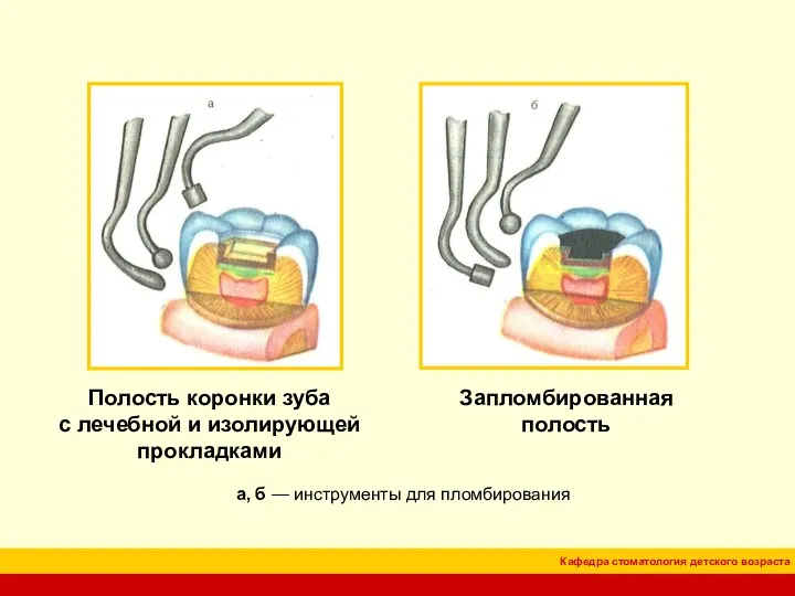 Полость коронки зуба с лечебной и изолирующей прокладками а, б — инструменты для пломбирования Запломбированная полость