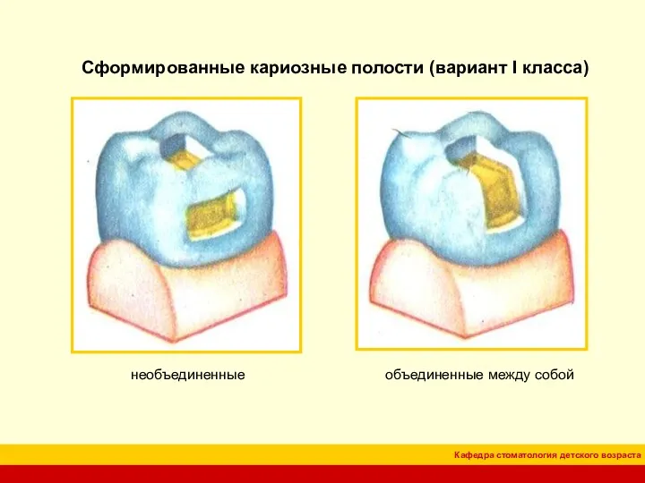 Сформированные кариозные полости (вариант I класса) необъединенные объединенные между собой