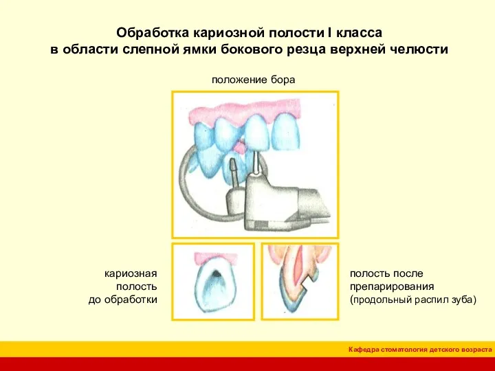 Обработка кариозной полости I класса в области слепной ямки бокового