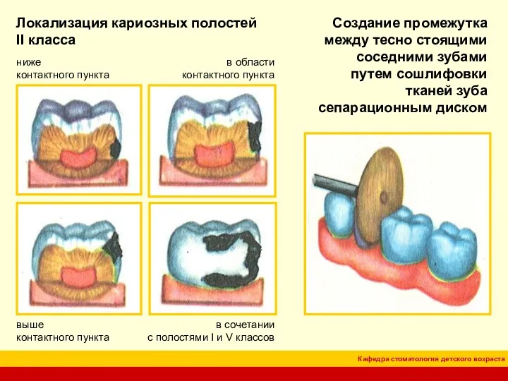 Локализация кариозных полостей II класса в области контактного пункта ниже