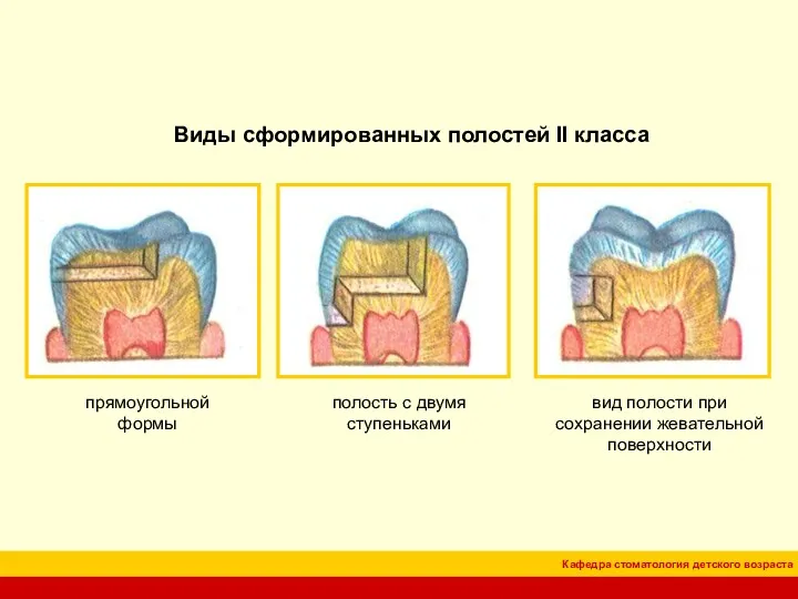 Виды сформированных полостей II класса прямоугольной формы полость с двумя