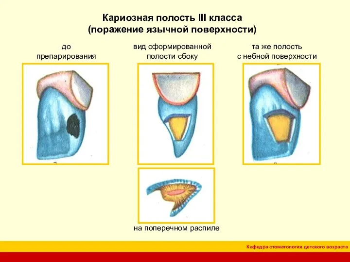 Кариозная полость III класса (поражение язычной поверхности) до препарирования вид