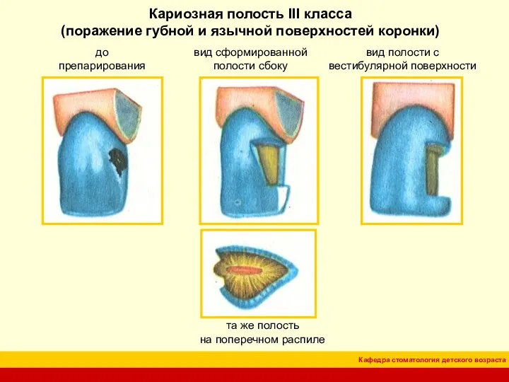 Кариозная полость III класса (поражение губной и язычной поверхностей коронки) до препарирования вид